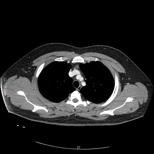 Bronchial carcinoid tumor (Radiopaedia 78272-90875 A 29).jpg