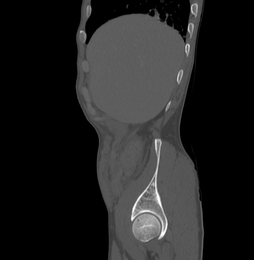 Bronchiectasis in Crohn disease (Radiopaedia 60311-67977 Sagittal bone window 17).jpg