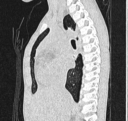 Bronchiolitis obliterans (Radiopaedia 71538-81897 Sagittal lung window 29).jpg