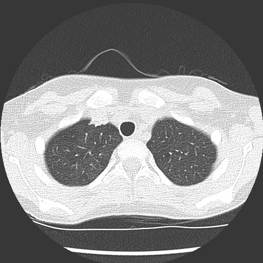 Bronchiolotis obliterans (Radiopaedia 73769-84575 Axial lung window 8).jpg