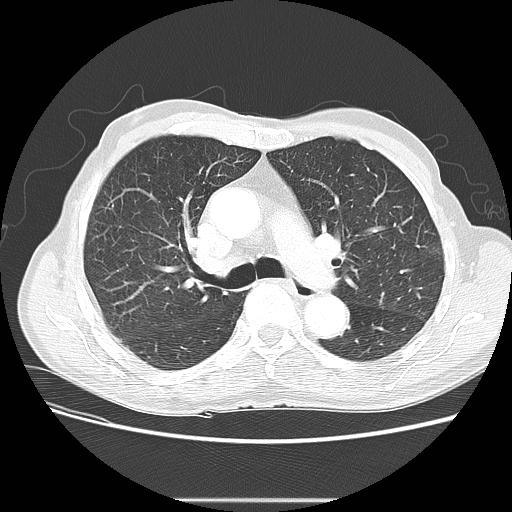 Bronchocele (Radiopaedia 17097-16795 Axial lung window 49).jpg
