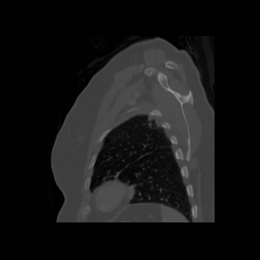 Bronchogenic carcinoma (Radiopaedia 73497-84262 Sagittal bone window 127).jpg