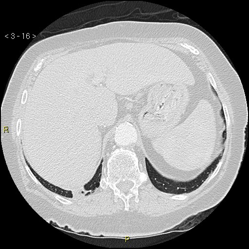 File:Bronchogenic carcinoma as an incidental finding (Radiopaedia 16453-16130 Axial lung window 16).jpg