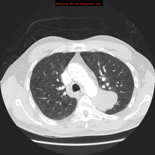 File:Bronchogenic carcinoma brain metastasis (Radiopaedia 9286-105832 Axial lung window 14).jpg