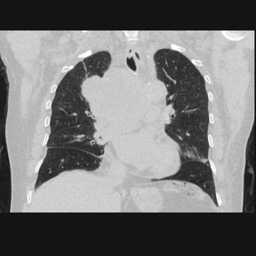 File:Bronchogenic carcinoma with metastatic lymphadenopathy (Radiopaedia 37671-39569 Coronal lung window 23).jpg