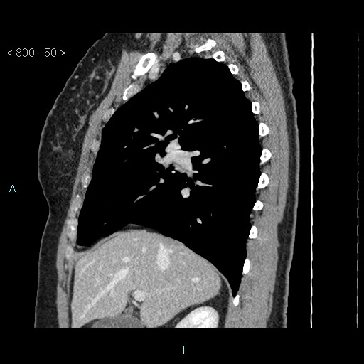Bronchogenic cyst - posterior mediastinal (Radiopaedia 43885-47364 B 33).jpg