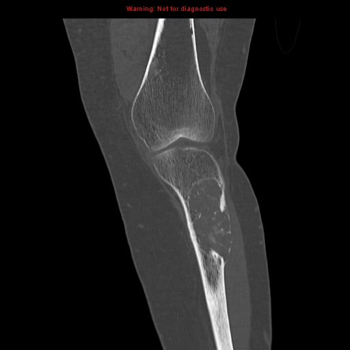 File:Brown tumors (Radiopaedia 9666-10291 Coronal bone window 9).jpg
