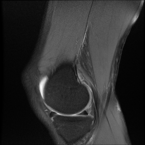 File:Bucket-handle meniscus tear (Radiopaedia 65700-74809 Sagittal PD fat sat 7).jpg