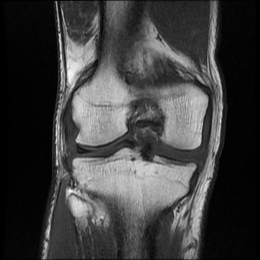 File:Bucket handle tear - medial meniscus (Radiopaedia 69245-79026 Coronal T1 13).jpg