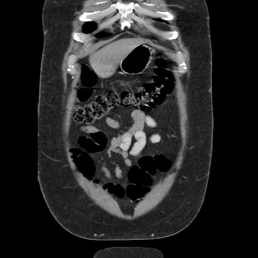 Burned-out testicular seminoma - retroperitoneal nodal metastases (Radiopaedia 62872-71245 B 13).jpg