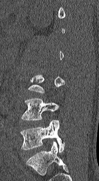 Burst fracture (Radiopaedia 53373-59357 Sagittal bone window 64).jpg