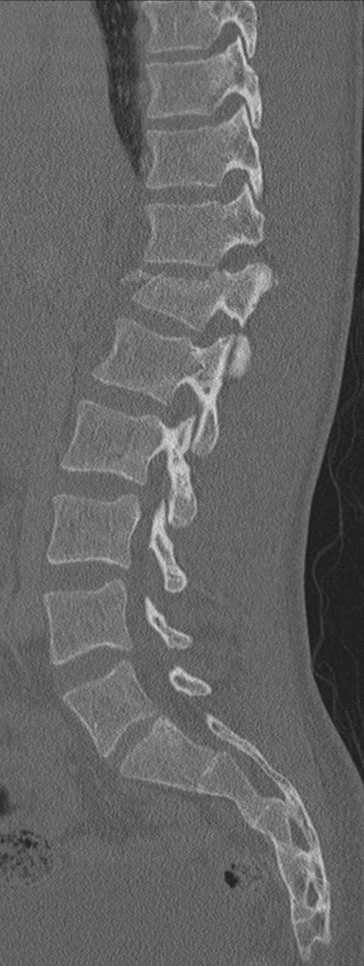 Burst fracture - T12 with conus compression (Radiopaedia 56825-63647 Sagittal bone window 50).png