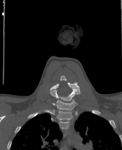 Butterfly vertebra (Radiopaedia 77903-90209 Coronal bone window 45).jpg