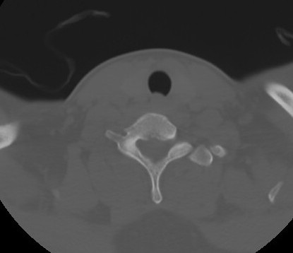 C7 laminar fracture and Klippel-Feil syndrome (Radiopaedia 86710-102850 Axial bone window 59).jpg