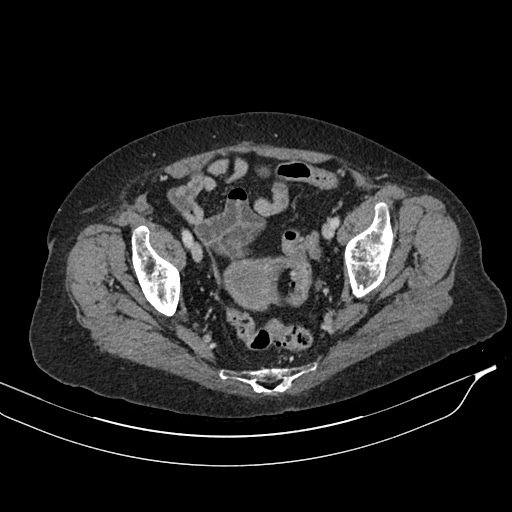 Calcified adrenal glands and Spigelian hernia (Radiopaedia 49741-54988 A 207).jpg