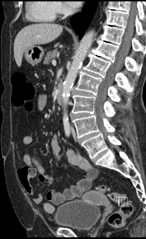 Calcified adrenal glands and Spigelian hernia (Radiopaedia 49741-54988 C 83).jpg
