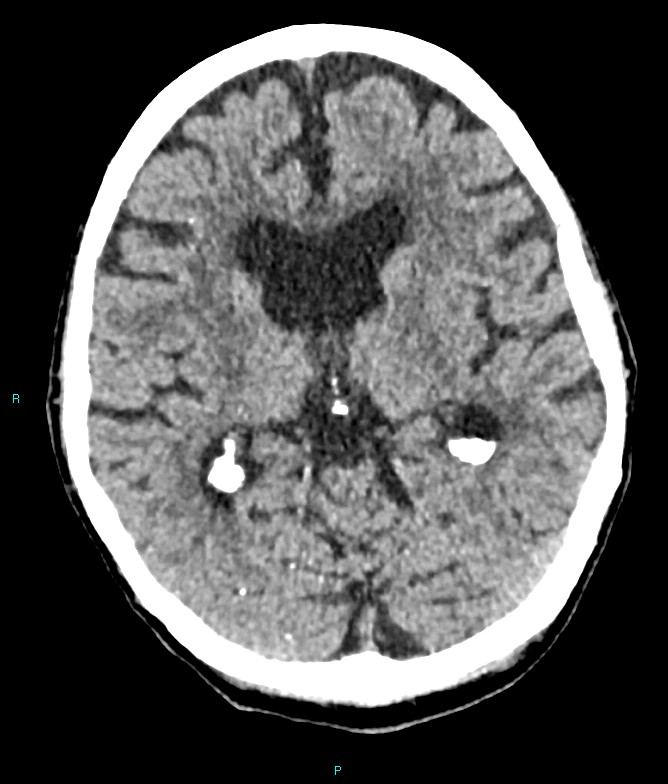 Calcified cerebral emboli from left ventricular thrombus (Radiopaedia 84420-99758 Axial non-contrast 49).jpg