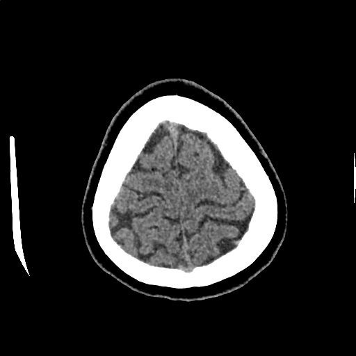 Calcified cerebral hydatid cyst (Radiopaedia 65603-74717 Axial non-contrast 72).jpg