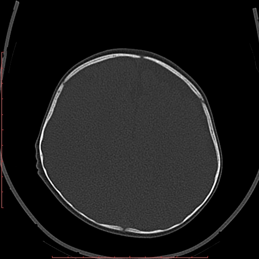 Calcified middle cerebral artery embolism (Radiopaedia 78949-91860 Axial bone window 51).jpg