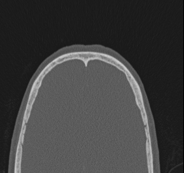 Caldwell-Luc operation (Radiopaedia 52329-58225 Axial bone window 5).jpg
