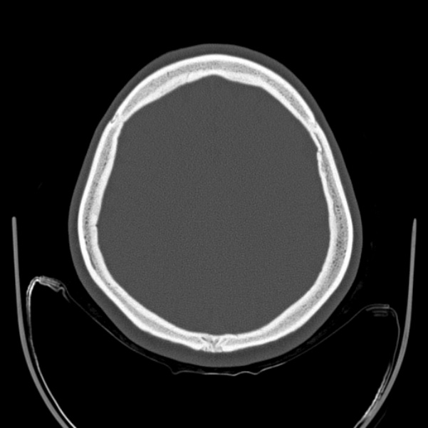 Calvarial osteoma (Radiopaedia 36520-38079 Axial bone window 81).jpg