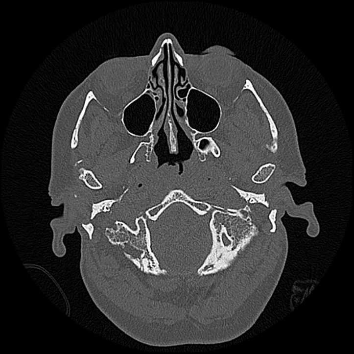 Canal up mastoidectomy (Radiopaedia 78108-90638 Axial bone window 21).jpg