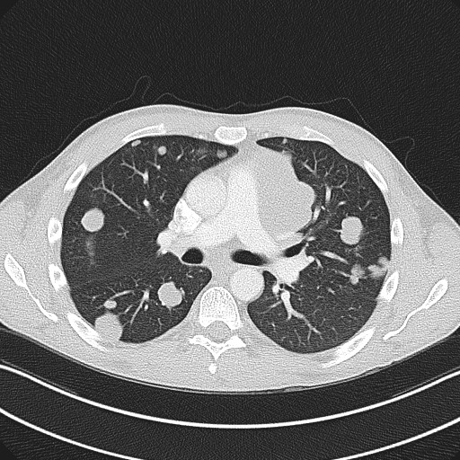 Cannonball metastases - testicular choriocarcinoma (Radiopaedia 84510-99891 Axial lung window 45).jpg