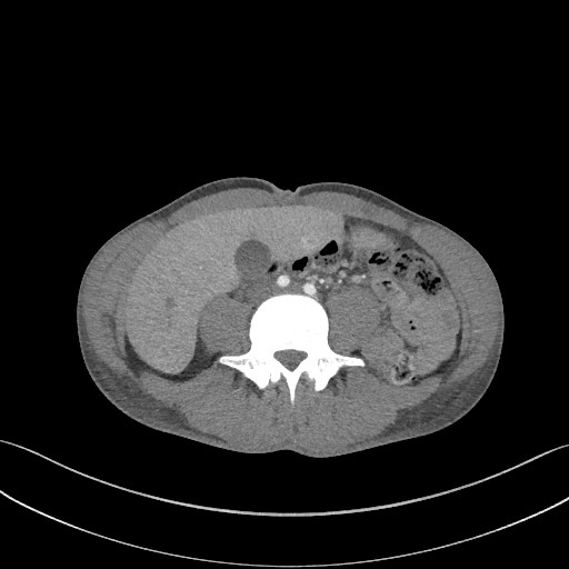 Cannonball metastases - testicular choriocarcinoma (Radiopaedia 84510-99891 B 146).jpg
