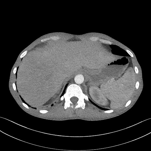 Cannonball metastases - testicular choriocarcinoma (Radiopaedia 84510-99891 B 98).jpg