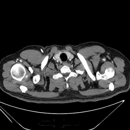 File:Cannonball pulmonary metastases (Radiopaedia 67684-77101 D 5).jpg