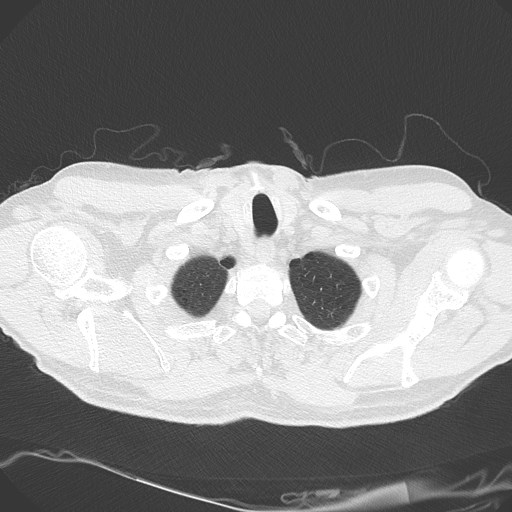 Caplan syndrome (Radiopaedia 56667-63530 Axial lung window 22).jpg
