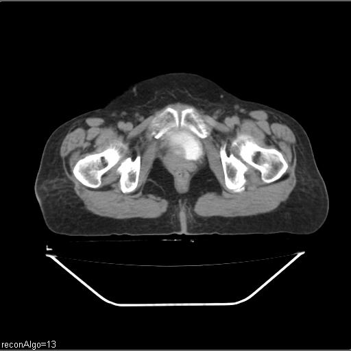 File:Carcinoma cervix- recurrence (Radiopaedia 34702-36137 B 90).jpg
