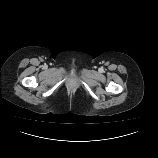Carcinoma colon - hepatic flexure (Radiopaedia 19461-19493 A 138).jpg