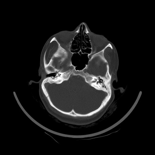 Carcinoma of the maxillary antrum (Radiopaedia 53805-59888 Axial bone window 33).jpg