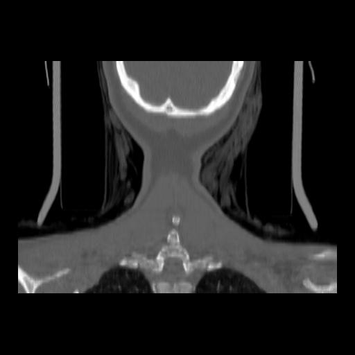 Carcinoma of the maxillary antrum (Radiopaedia 53805-59888 Coronal bone window 143).jpg