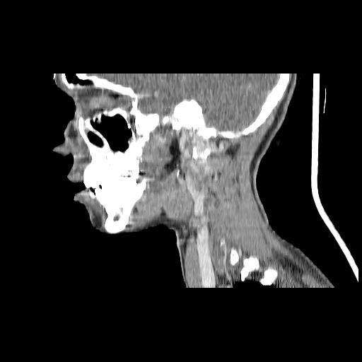 Carcinoma of the maxillary antrum (Radiopaedia 53805-59888 Sagittal C+ delayed 123).jpg