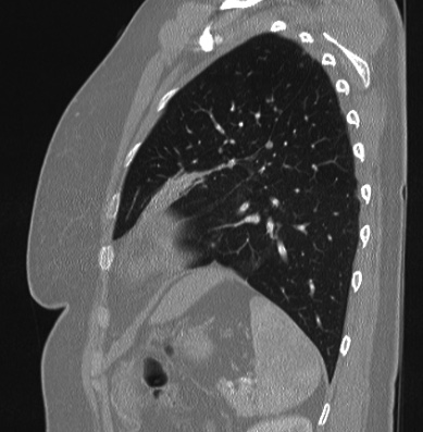 Cardiac sarcoidosis (Radiopaedia 74548-85534 Sagittal lung window 21).jpg