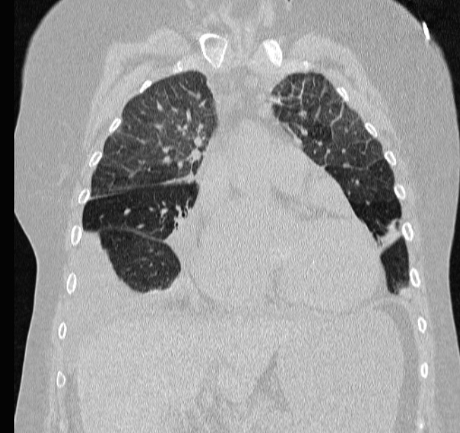 Cardiogenic pulmonary edema (Radiopaedia 29213-29609 Coronal lung window 24).jpg