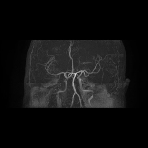 Carotid arterial dissection with acute cerebral infarction (Radiopaedia 26636-26784 MRA 10).jpg
