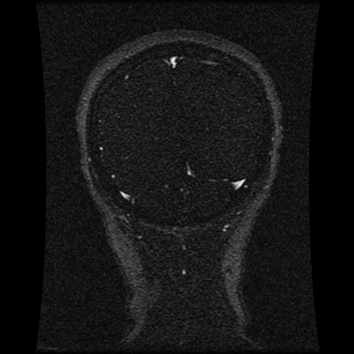 Carotid arterial dissection with acute cerebral infarction (Radiopaedia 26636-26784 MRV 52).jpg
