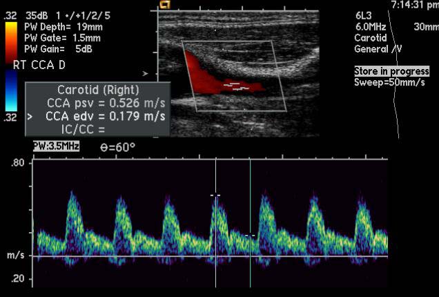 File:Carotid artery stenosis (Radiopaedia 11280-11644 Longitudinal 1).jpg