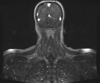 Carotid body tumor (Radiopaedia 12777-12912 MRA 67).jpg