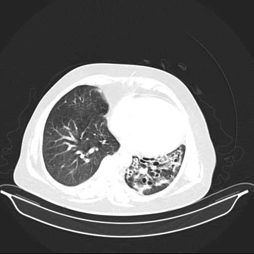 File:Carotid body tumor (Radiopaedia 21021-20948 Axial lung window 29).jpg