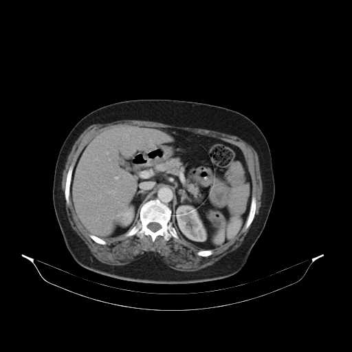 File:Carotid body tumor (Radiopaedia 21021-20948 B 66).jpg