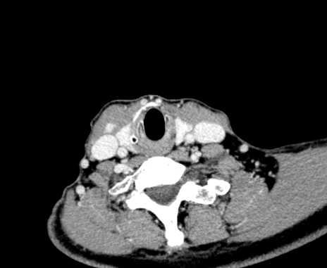File:Carotid body tumor (Radiopaedia 61750-69757 Axial Post contrast 90).jpg