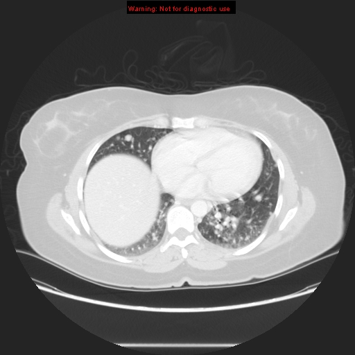 Carotid body tumor with lung metastases (Radiopaedia 9301-48390 Axial lung window 46).jpg