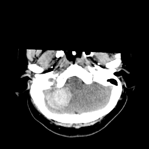 Cavernoma with hemorrhage (Radiopaedia 70755-80931 Axial non-contrast 10).png