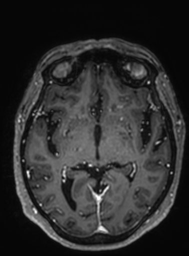 File:Cavernous hemangioma of the cerebellar falx (Radiopaedia 73025-83724 Axial T1 C+ 183).jpg