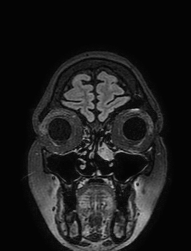 Cavernous hemangioma of the cerebellar falx (Radiopaedia 73025-83724 Coronal FLAIR 29).jpg