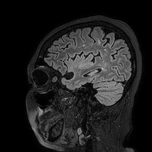 File:Cavernous hemangioma of the cerebellar falx (Radiopaedia 73025-83724 Sagittal FLAIR 46).jpg
